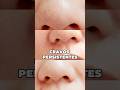 Cravos Persistentes #cravosnonariz #dermatologista #limpezadepele #skincare