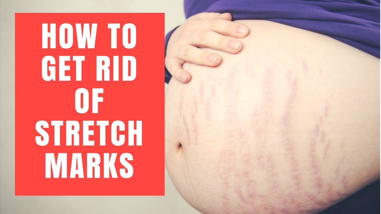 How To Get Rid Of STRETCH MARKS In Pregnancy How to Remove Stretch