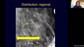 Breast Imaging Calcifications - module 4 | Health4TheWorld Academy