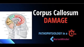 Pathophysiology for Nursing: Corpus Callosum and the Nervous System