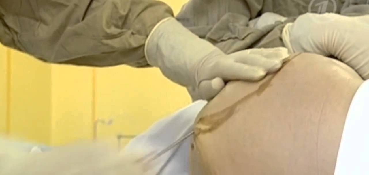 Липосакция мифы и правда!