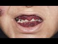 How To Get Rid Of Calcium Buildup On Teeth