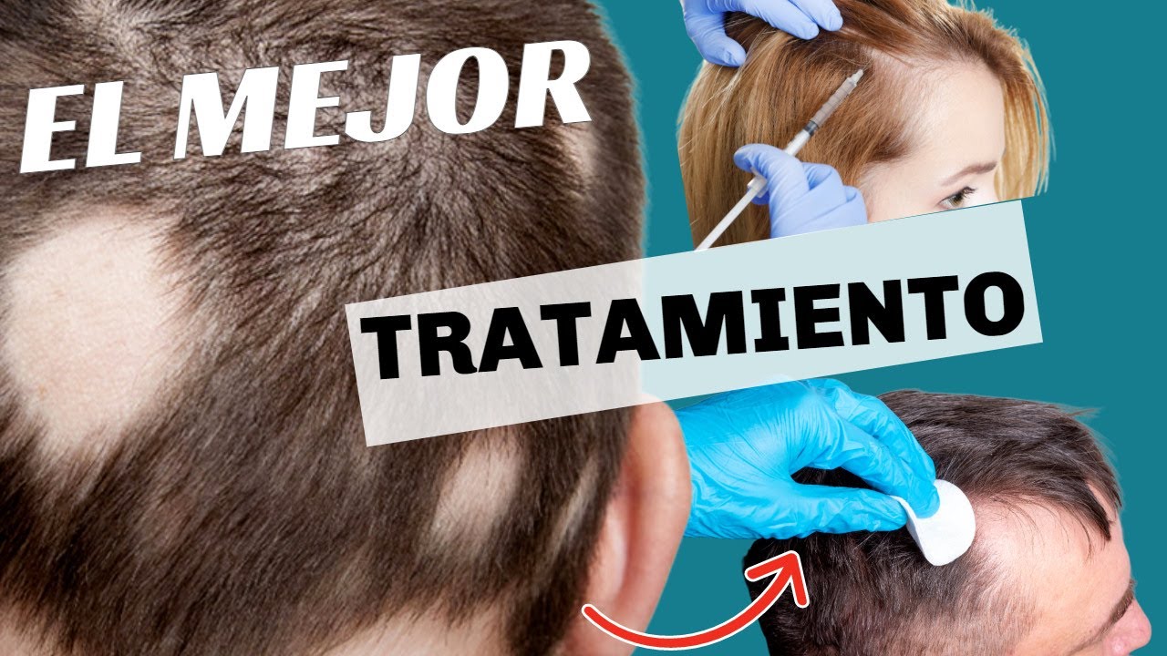 Alopecia | Tratamiento en Hombres y Mujeres - YouTube