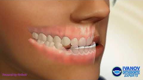 How to fix Underbite with Braces