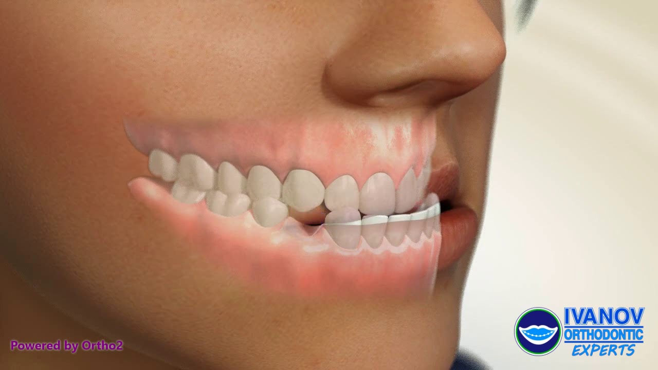 What Are The Signs That Indicate An Underbite? What Are The Signs That Indicate An Underbite?