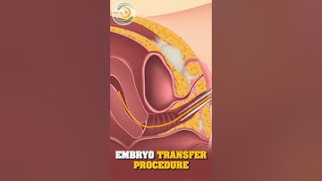 Embryo Transfer Procedure | Best Gynecology Doctor in Kanpur