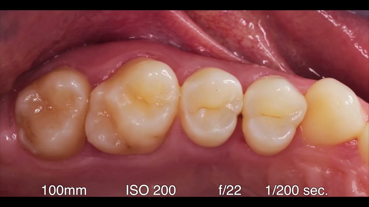 5- Okluzal Fotoğraf Çekimi