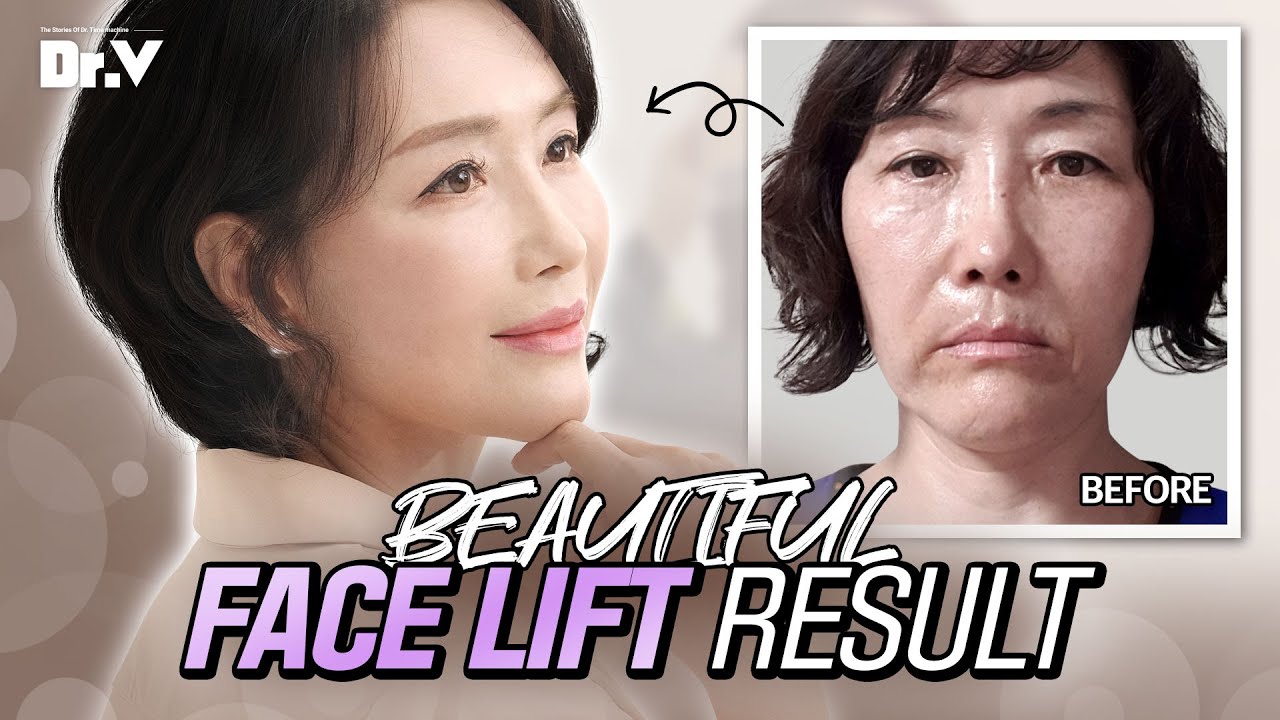 [Korea Plastic Surgery Review] Facelift, Infrabrow Blepharoplasty At V ...