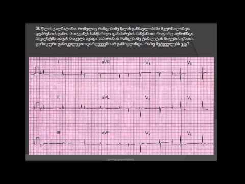ეკგ. ლითიუმის პრეპარატებით გამოწვეული T კბილების ინვერსია / ლითიუმი / ლითიუმის კარბონატი / დეპრესია