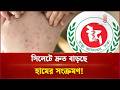 হামের উপসর্গ নিয়ে হাসপাতালে বেড়েই চলছে রোগী | Measles Outbreak | Independent TV