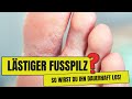 Lästiger Fußpilz? So wirst du ihn los!