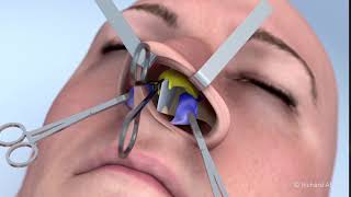 Rhinoplastie Esthétique Ou Fonctionnelle Marseille Docteur Abs