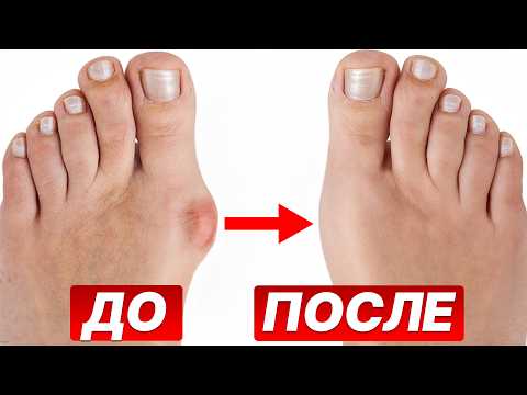 Шишка на большом пальце УШЛА! Как ЛЕГКО избавиться от косточки на ноге?