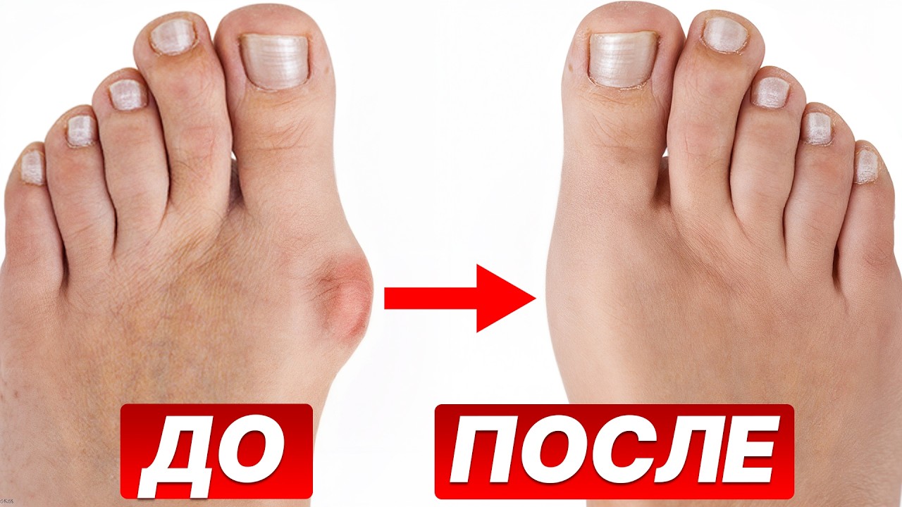 Эти 5 упражнений лучше всего убирают косточку на ноге