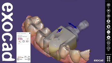 exocad Basic Guide: Learn more about the main indication of single-visit dentistry