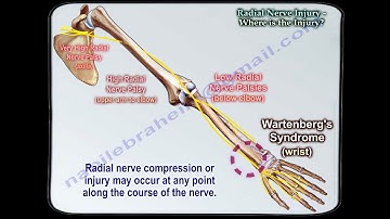 Radial Nerve Injury,Where Is The Injury - Everything You Need To Know - Dr. Nabil Ebraheim