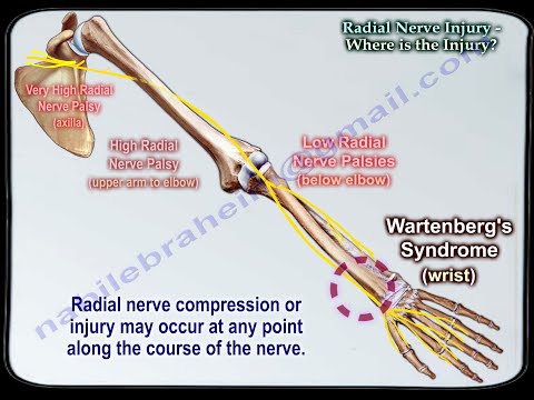 Radial Nerve Injury,Where Is The Injury - Everything You Need To Know - Dr. Nabil Ebraheim