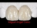 Realización de carillas de cerámica paso a paso. Miguel Angel Cano. www.dentalcano.com