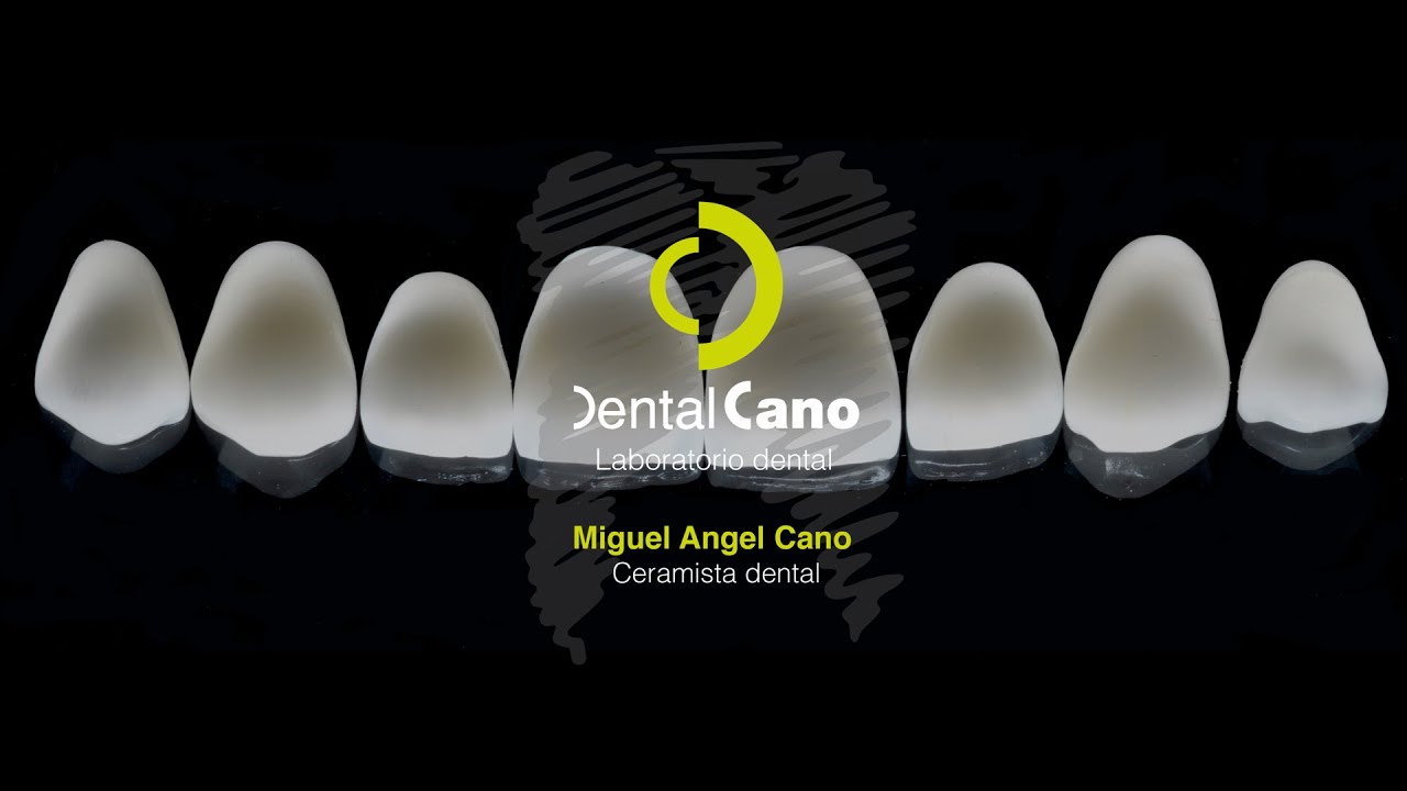 Realización de carillas de cerámica paso a paso. Miguel Angel Cano. www.dentalcano.com