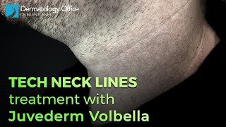 Tech Neck Lines Treatment With Juvederm Volbella