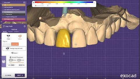 ExoCAD Tutorial - Implant Tooth Mirroring Part 1