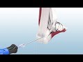 Haglund's Excision and Achilles Reconstruction Using the CuffLink™ System - CONMED Animation