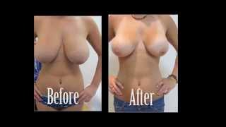 Breast Reduction Before & After pictures with Testimonial - Non-Surgical Laser Liosuction