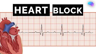 Heart Block | Av Block | Ecg | Ekg | Osce Guide | Ukmla | Cpsa