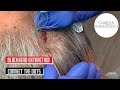 Blackheads extraction from behind the head connect the dots