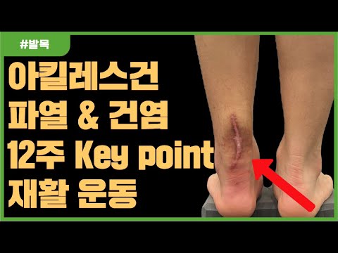 <strong>아킬레스건염</strong>. 12주 재활 전략 (실제 파열 재활 케이스)