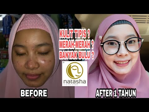 Zoom 1000x Pasca Peeling, Pantes Aja Glowing! | Before-After Chemical Peeling dr. Irfan Prasetya. 