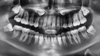 Impacted Canines https://www.straightsmilesolutions.com/