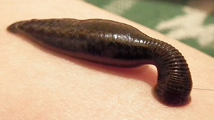 Girl Finds A 3-Inch Leech Living In Her Face! (PHO...
