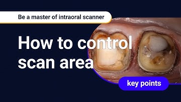 Be a master of intraoral scanner : by controlling soft tissue before scanning