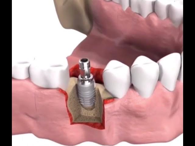 Beesjuy Kit de Protección Dental 4Pcs, Ferula Descarga Bruxismo