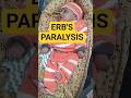 Erbs Paralysis treatment #trends #trending #viral #erbsparalysis #doctor #hospital #orthopedic