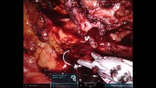 Robotic pyeloplasty on the right side   Part09