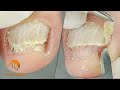 2 cases 1 video (XI) | #1 Onychomycosis | #2 Onychogryphosis [Podological treatment]