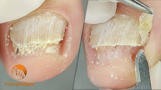 2 cases 1 video (XI) | #1 Onychomycosis | #2 Onychogryphosis [Podological treatment]