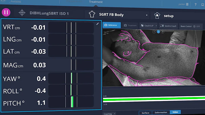 AlignRT Advance Breath Hold Overview:
