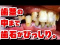 【接写】歯茎の中まで歯石がびっしり。[续篇][Close-up]