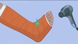 العناية بالجبس والجبيرة care of cast and splints