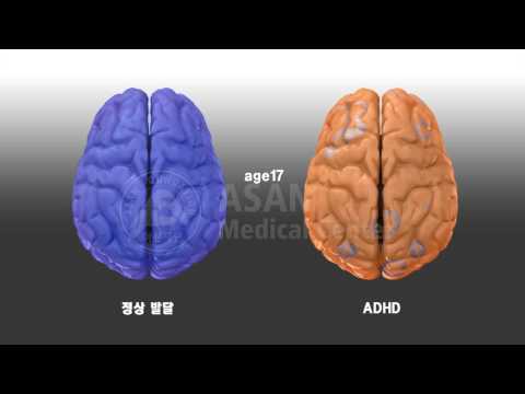 Compare normal vs ADHD brain