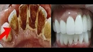 لا وصفات و لا أكاذيب الطريقة العلمية الوحيدة لإزالة الجير على الأسنان