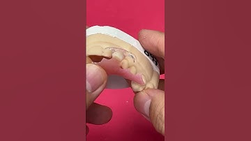 Acrylic Partial with Clear Clasps @EnvisiontecMain #envisiontec #dentist #short #shorts #shortvideo