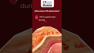 FFR   Angioplasty