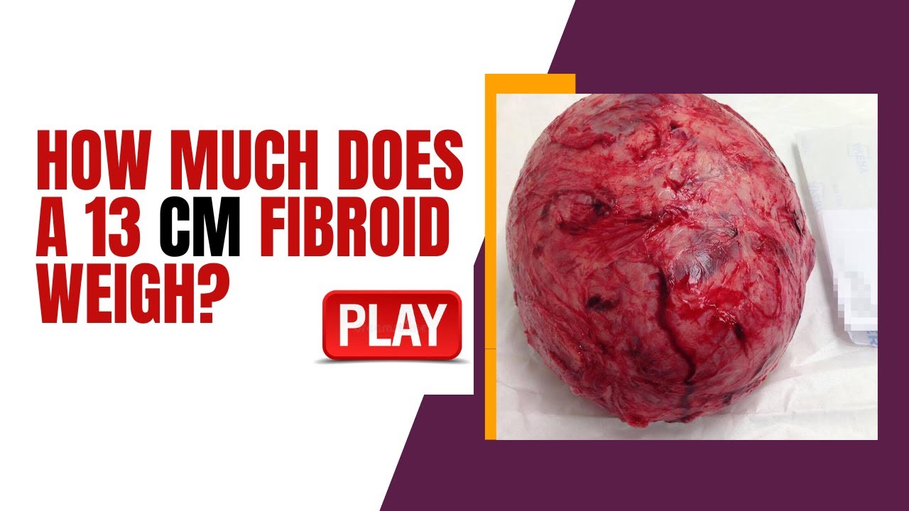 How Much does a 13 CM Fibroid Weigh? [EXPLAINED] - YouTube