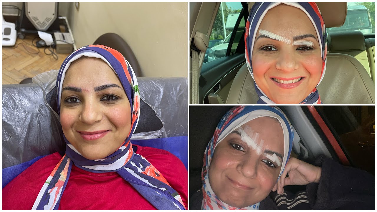 قبل الخياطة وبعدها..تجربتي مع إصابة الوجه وعلاجها لعلها تفيد أي حد ❤️ #سارة_عبدالسلام
