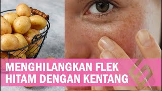 Cara Menghilangkan Flek Hitam dengan Kentang, Ada 3 Metode Cara Menghilangkan Flek Hitam dengan Kentang, Ada 3 Metode