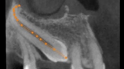 Autotransplantacja zęba zatrzymanego; tooth autotransplantation